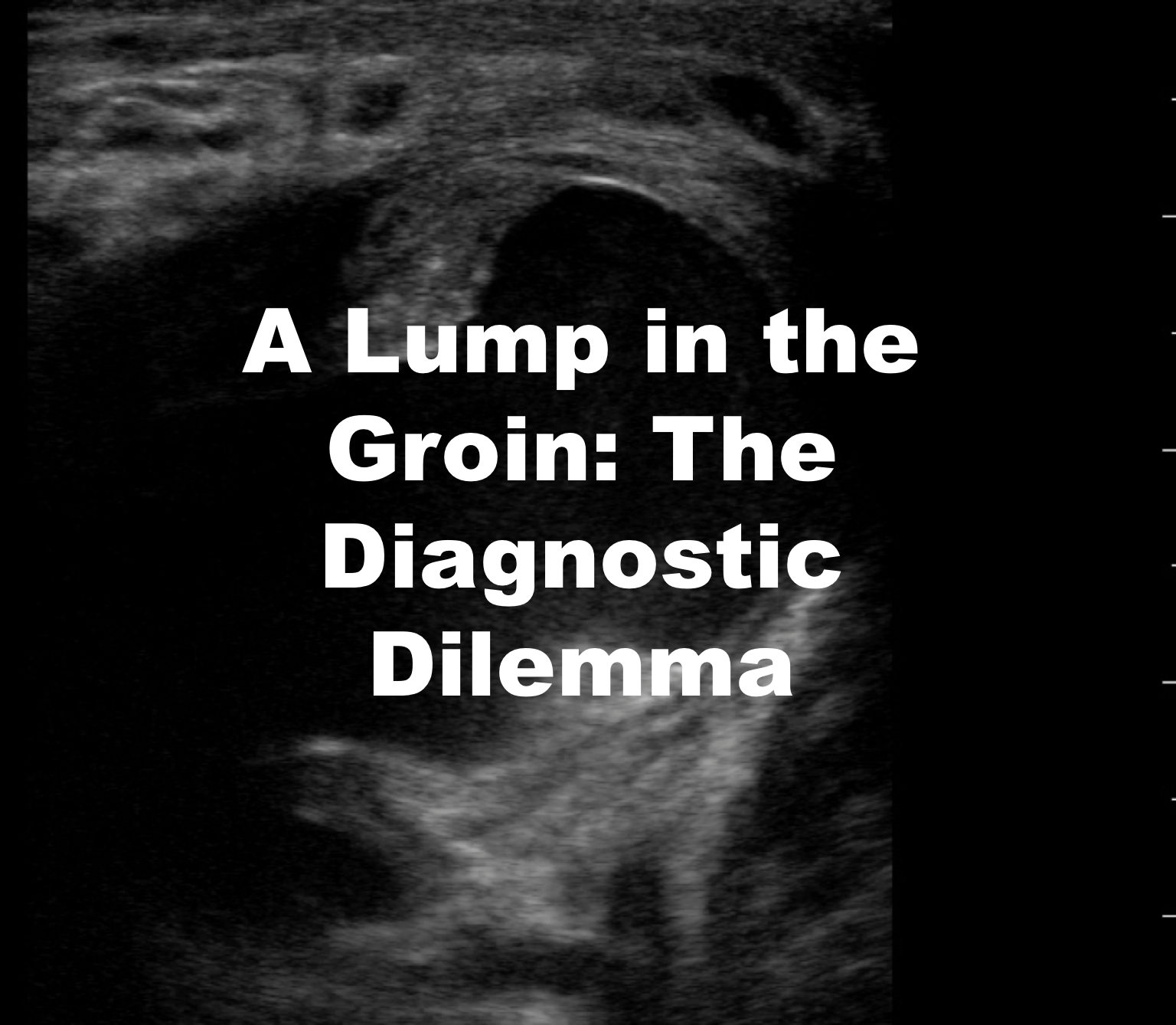 emdocs-emergency-medicine-educationa-lump-in-the-groin-the